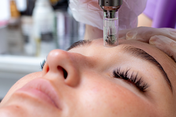 Microneedling in Mömbris